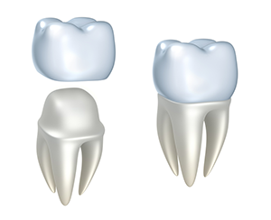 illustration of assembly of dental crowns Manteca, CA